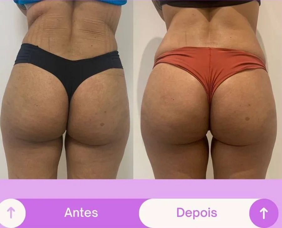 Antes e depois harmonização glútea