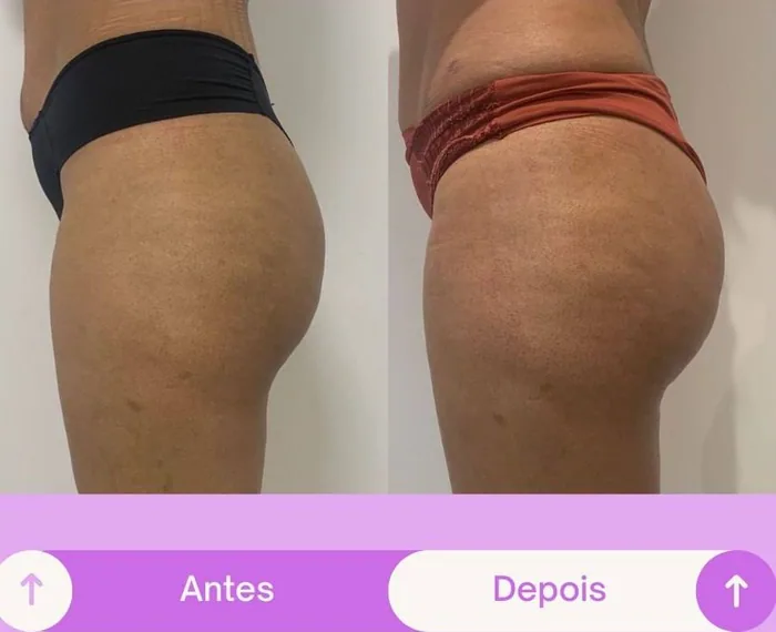 Antes e depois, projeção de perfil