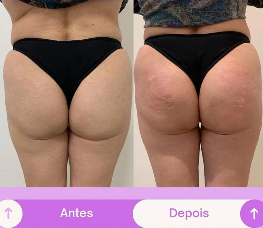Antes e depois 2