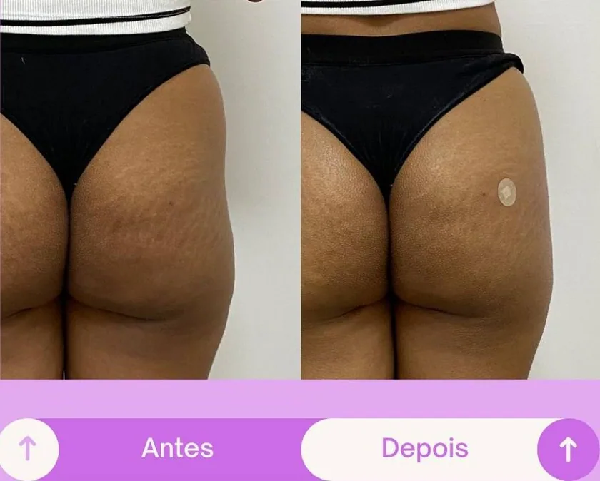 Antes e depois 4