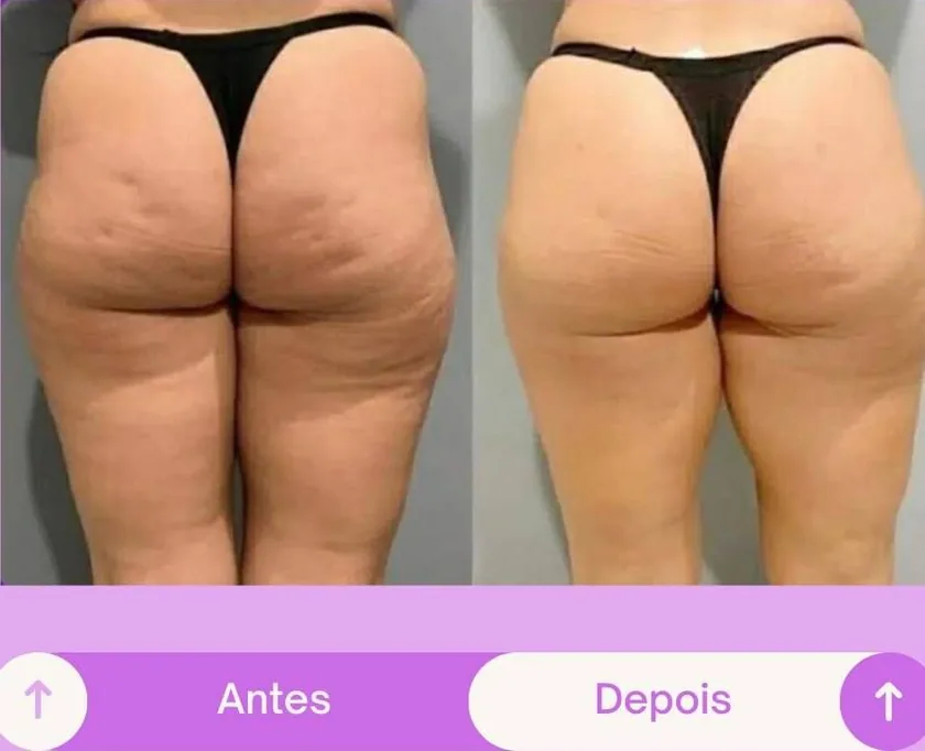 Antes e depois 5